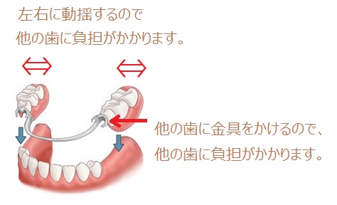 左右に動揺するので他の歯に負担がかかります。他の歯に金具をかけるので他の歯に負担がかかります。