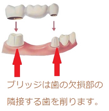 ブリッジは歯の欠損部の隣接する歯を削ります。