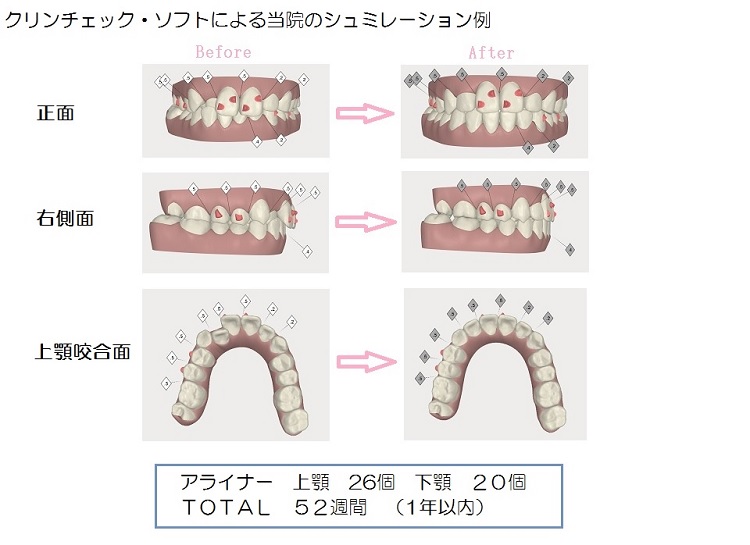 クリンチェック・ソフトによる当院のシミュレーション例1