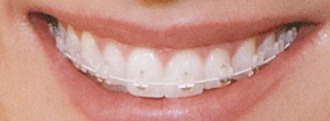 ホワイト&ホワイト歯列矯正イメージ