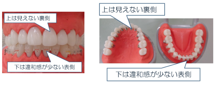 ハーフリンガル歯列矯正イメージ1